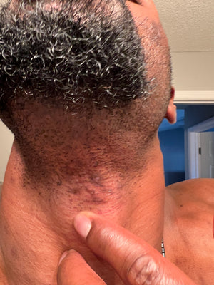 Ingrown Hair Bump Treatment Mist