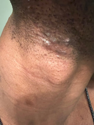 Ingrown Hair Bump Treatment Mist